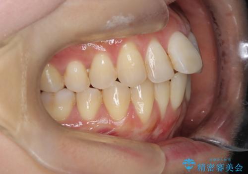 半年で改善した上顎前歯の突出の治療前