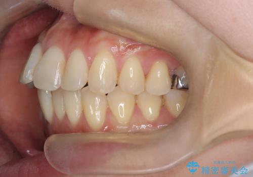 半年で改善した上顎前歯の突出の治療前