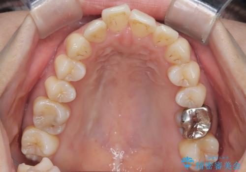 半年で改善した上顎前歯の突出の治療前
