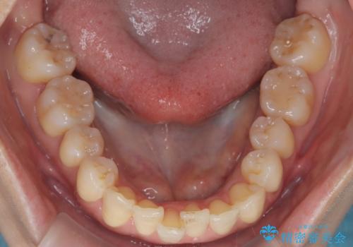 半年で改善した上顎前歯の突出の治療前