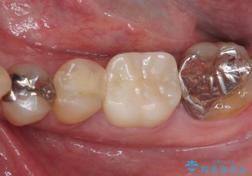 何度通院しても痛みが引かない 転医による根管治療の治療中