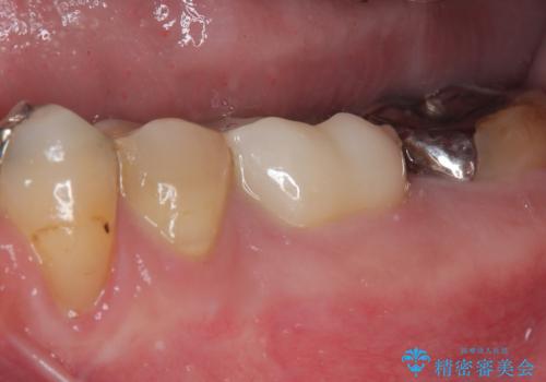 何度通院しても痛みが引かない 転医による根管治療の治療後