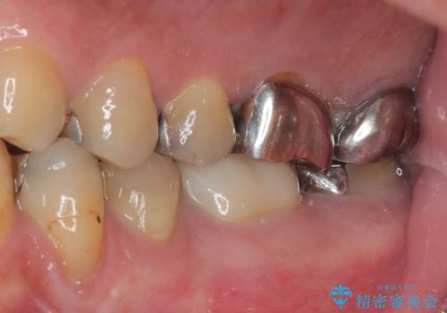 何度通院しても痛みが引かない 転医による根管治療の治療中