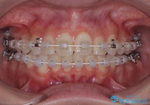 前歯のデコボコを治したい 目立たないワイヤー装置での矯正治療の治療中