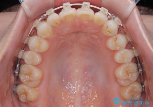 前歯のデコボコを治したい 目立たないワイヤー装置での矯正治療の治療中
