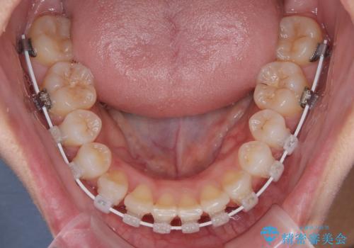 前歯のデコボコを治したい 目立たないワイヤー装置での矯正治療の治療中