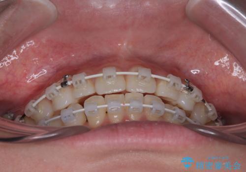 前歯のデコボコを治したい 目立たないワイヤー装置での矯正治療の治療中