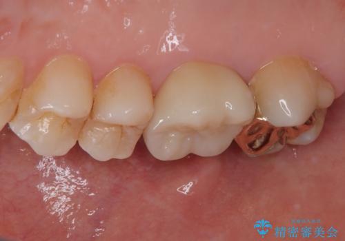銀歯をやり替えたい フルジルコニアクラウン・ゴールドインレー修復の治療後