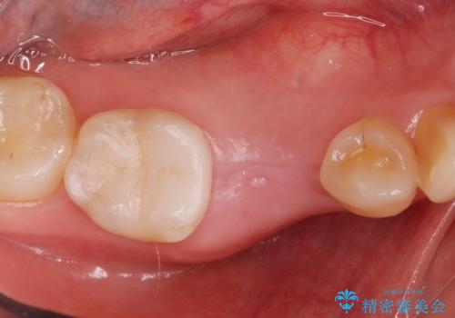 インプラント治療の治療前