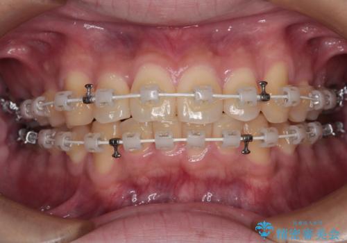 前歯のデコボコを治したい　ワイヤー装置での非抜歯矯正の治療中
