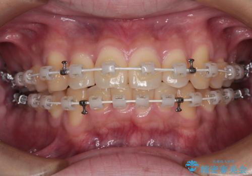 前歯のデコボコを治したい ワイヤー装置での非抜歯矯正の治療中