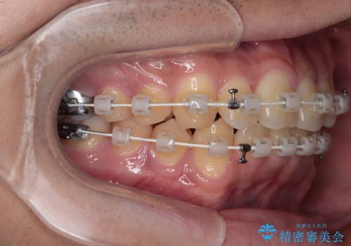 前歯のデコボコを治したい ワイヤー装置での非抜歯矯正の治療中