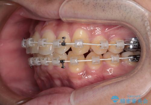 前歯のデコボコを治したい ワイヤー装置での非抜歯矯正の治療中