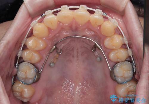 前歯のデコボコを治したい　ワイヤー装置での非抜歯矯正の治療中