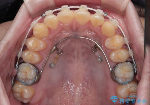 前歯のデコボコを治したい ワイヤー装置での非抜歯矯正の治療中