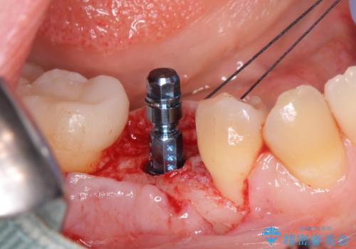 インプラント治療の治療中