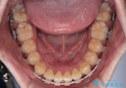 前歯のデコボコを治したい ワイヤー装置での非抜歯矯正の治療中