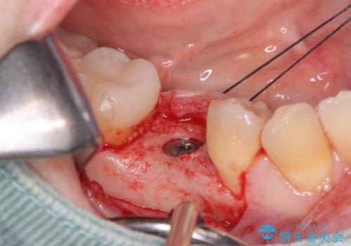 インプラント治療の治療中