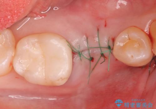 インプラント治療の治療後