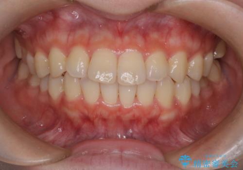 前歯と奥歯のガタガタを矯正で改善の症例 治療前