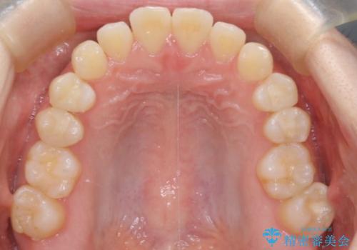 前歯と奥歯のガタガタを矯正で改善の治療前