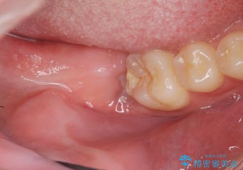 右下親知らず抜きたい。の治療前