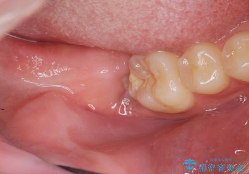 右下親知らず抜きたい。の症例 治療前