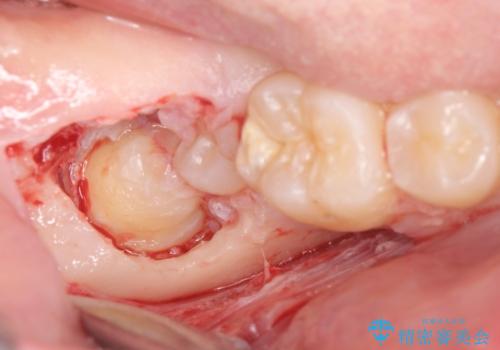 右下親知らず抜きたい。の治療中