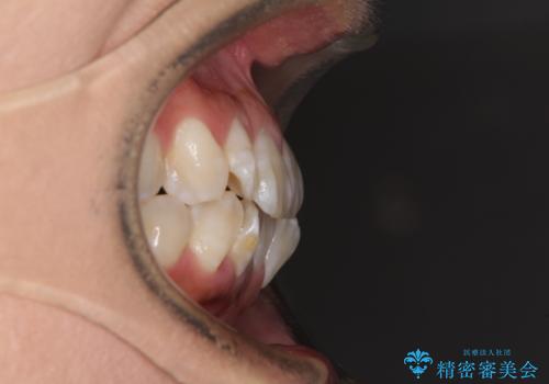 全く目立たないワイヤー矯正 上下裏側矯正の治療前