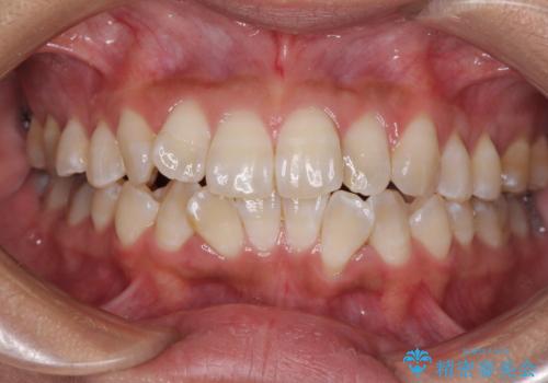 全く目立たないワイヤー矯正 上下裏側矯正の症例 治療前