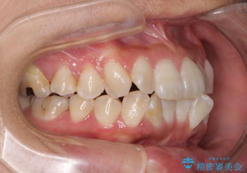 全く目立たないワイヤー矯正 上下裏側矯正の治療前