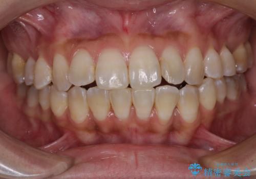 全く目立たないワイヤー矯正 上下裏側矯正の治療中