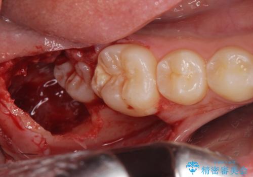 右下親知らず抜きたい。の治療中