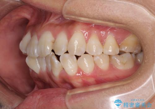 全く目立たないワイヤー矯正 上下裏側矯正の治療前