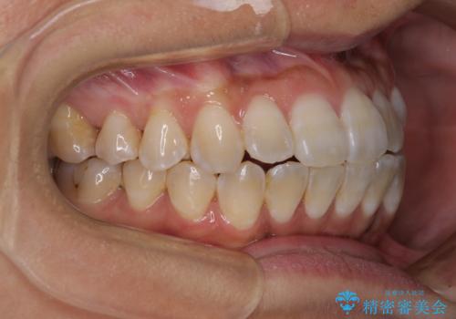 全く目立たないワイヤー矯正 上下裏側矯正の治療中