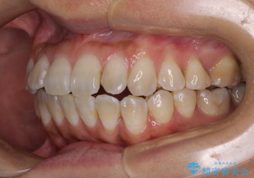 全く目立たないワイヤー矯正 上下裏側矯正の治療中