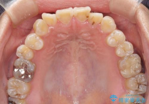 全く目立たないワイヤー矯正 上下裏側矯正の治療前