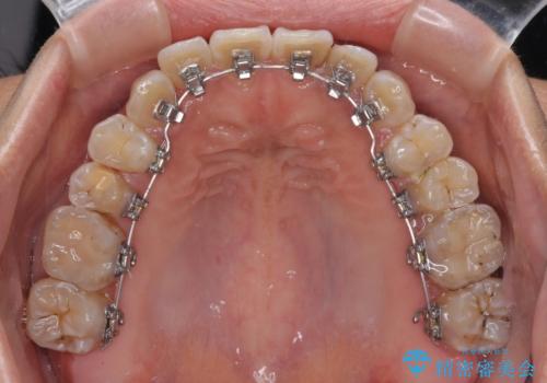 全く目立たないワイヤー矯正 上下裏側矯正の治療中