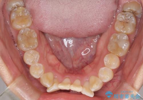 全く目立たないワイヤー矯正 上下裏側矯正の治療前