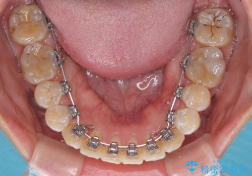 全く目立たないワイヤー矯正 上下裏側矯正の治療中