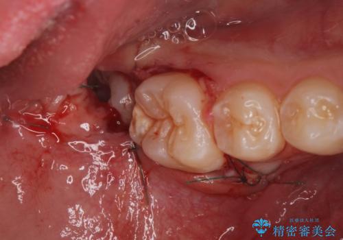 右下親知らず抜きたい。の治療後