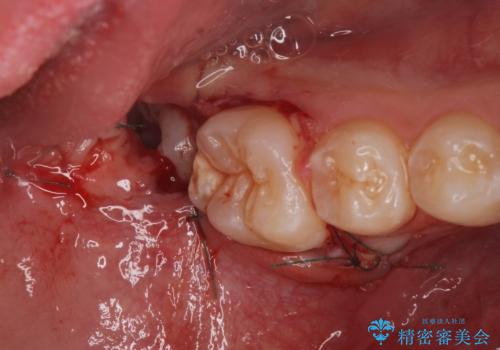 右下親知らず抜きたい。の症例 治療後