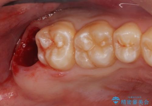 右下親知らず抜きたい。の治療後