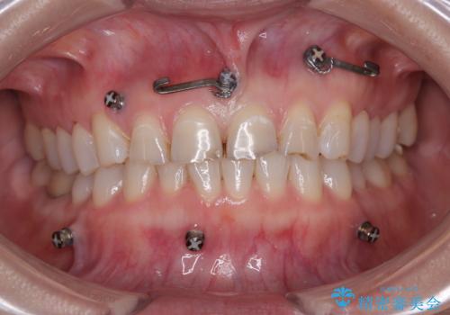 転んで欠けた前歯を治したい。オールセラミッククラウンによる補綴の症例 治療前