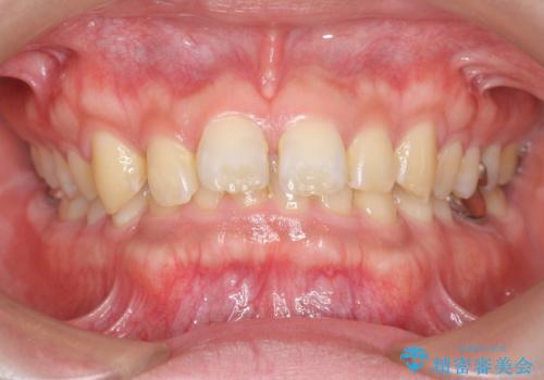 ディープバイトのマウスピース矯正の症例 治療前