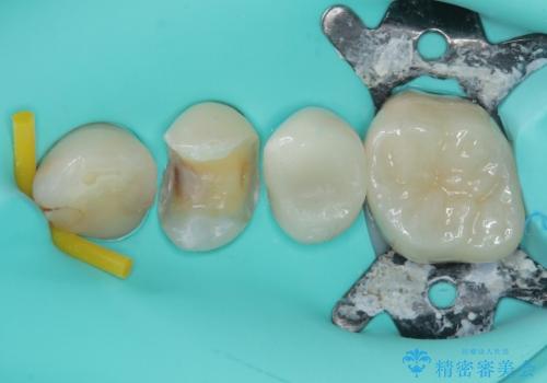 銀歯が取れたのでやり替えたい セラミックインレー修復の治療中