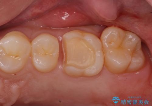 銀歯を無くしたい。の治療中