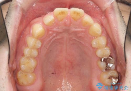 ディープバイトのマウスピース矯正の治療前