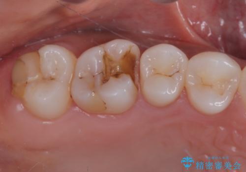 銀歯が外れてしまったのでセラミックにやり替えたい。セラミックインレー修復の治療前