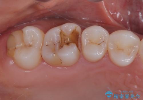 銀歯が外れてしまったのでセラミックにやり替えたい。セラミックインレー修復の症例 治療前